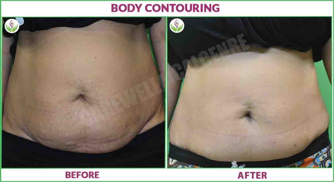 Body Contouring Before and After Results 1