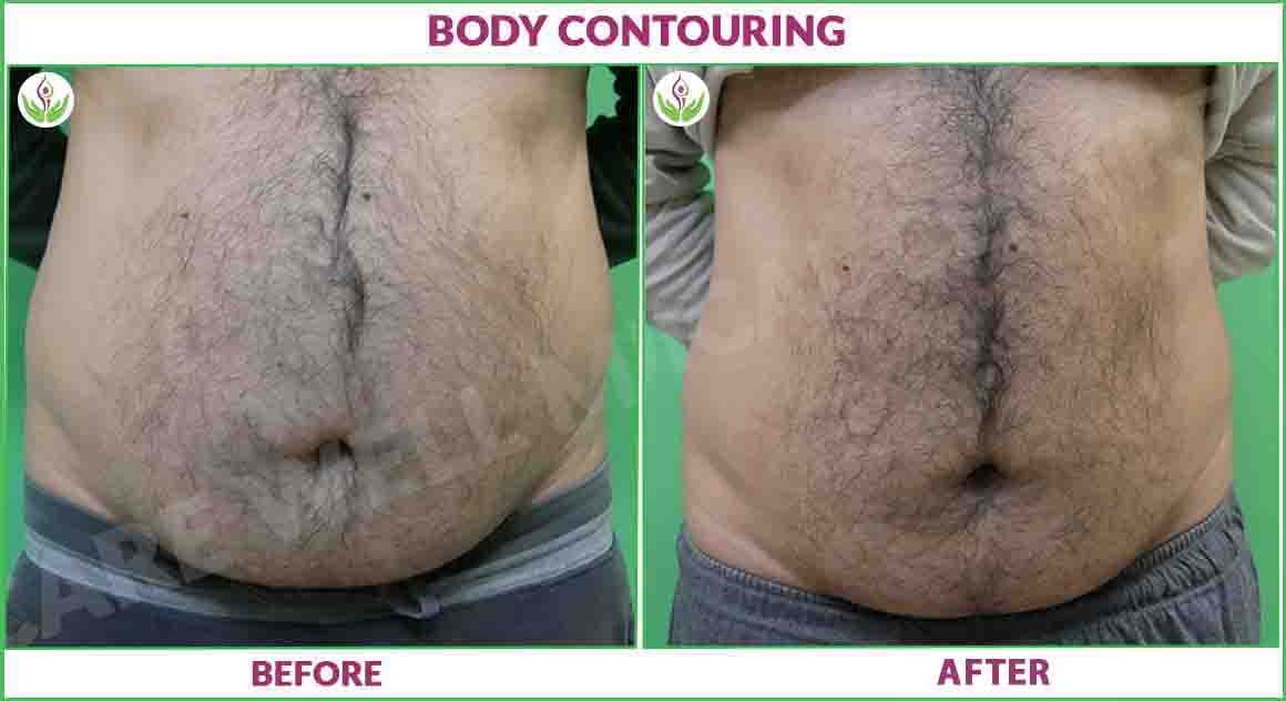 Body Contouring Before and After Results 2