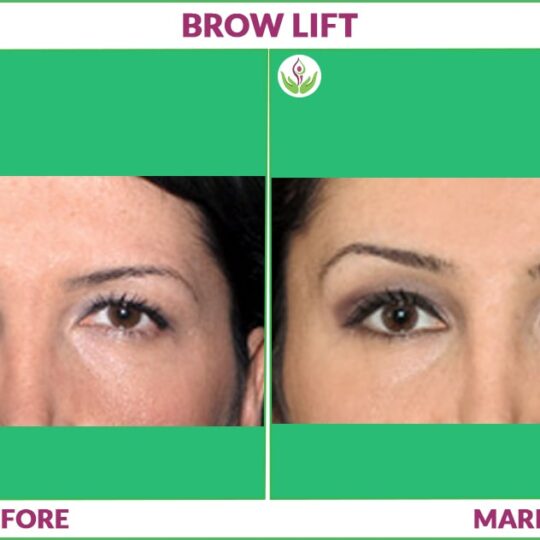 eyebrow lift before and after result photo