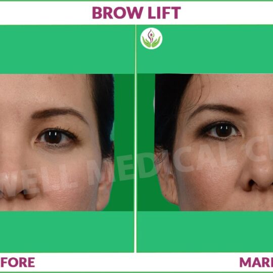 eyebrow lift before and after photo