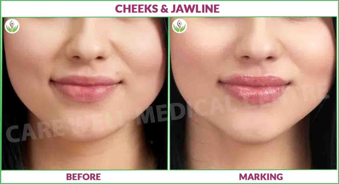 cheeks and jawline before and after photo