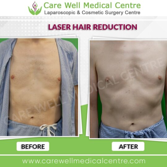 chest laser hair reduction before and after result