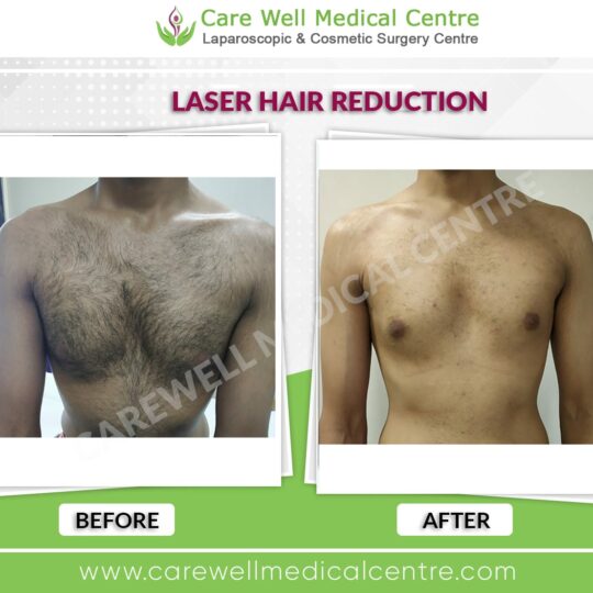 chest laser hair reduction before and after results