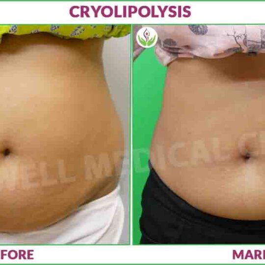 cryolipolysis before and after result