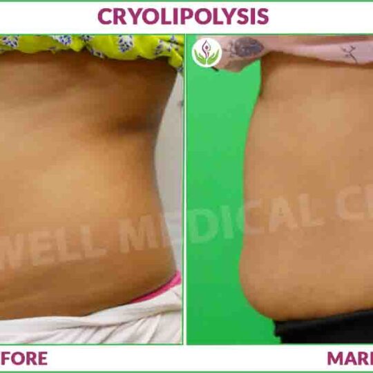 cryolipolysis before and after results