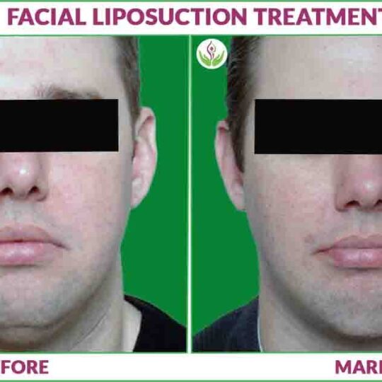 facial liposuction before and after photo