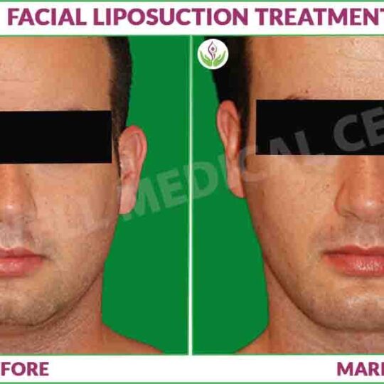 facial liposuction before and after results