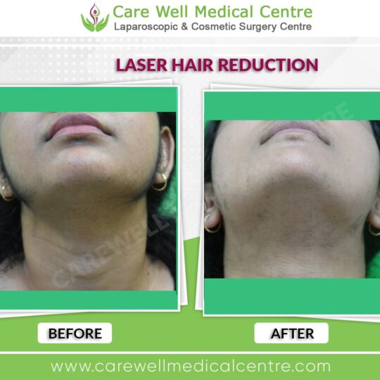 female laser hair reduction result