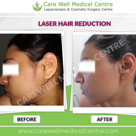 female laser hair reduction results