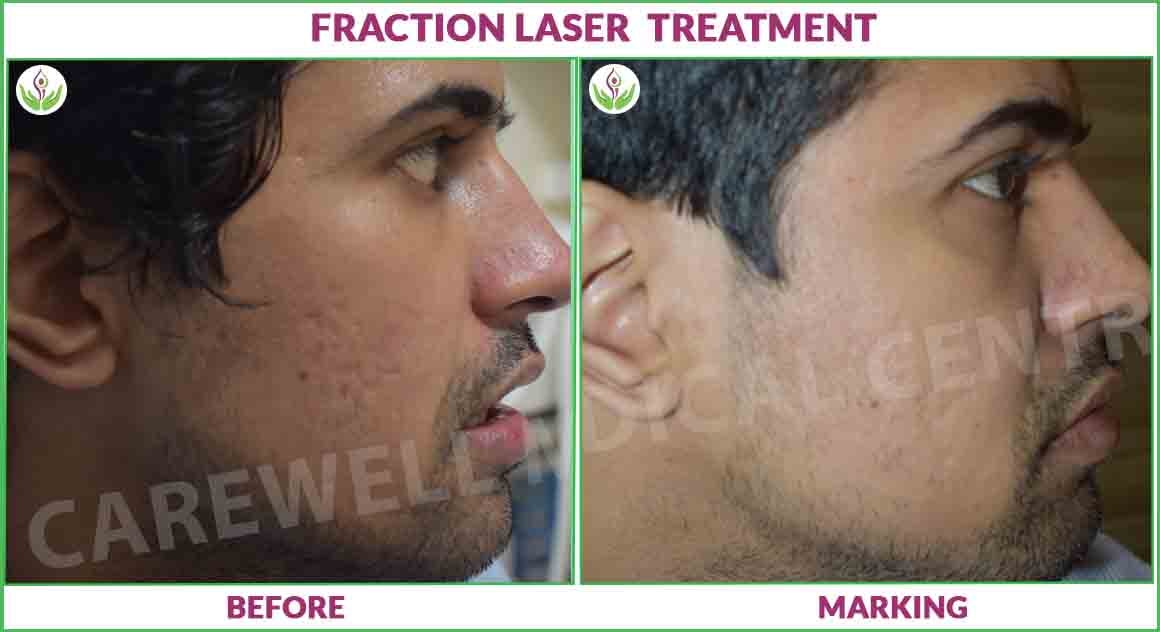 fraction laser treatment before and after photo