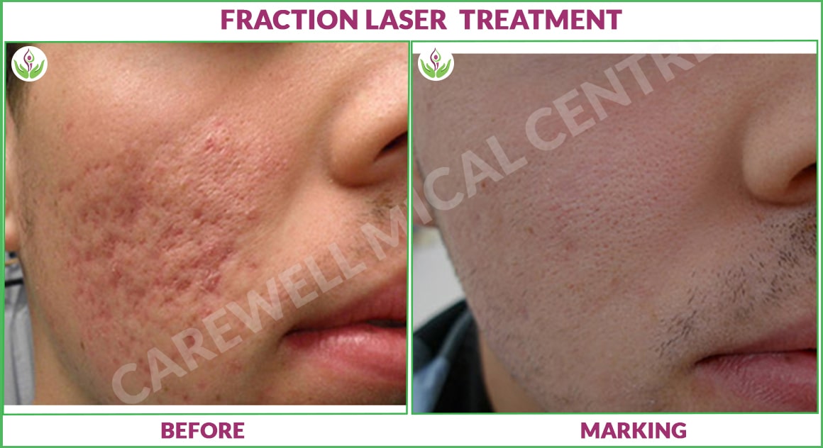 fraction laser treatment before and after results photo