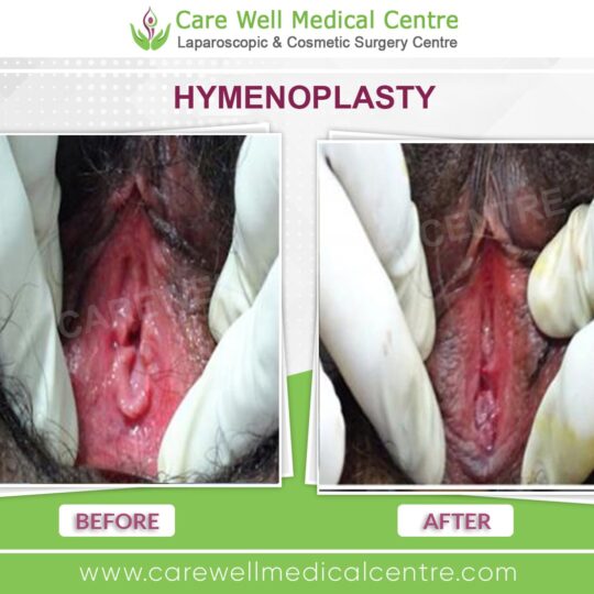 hymenoplasty before and after result