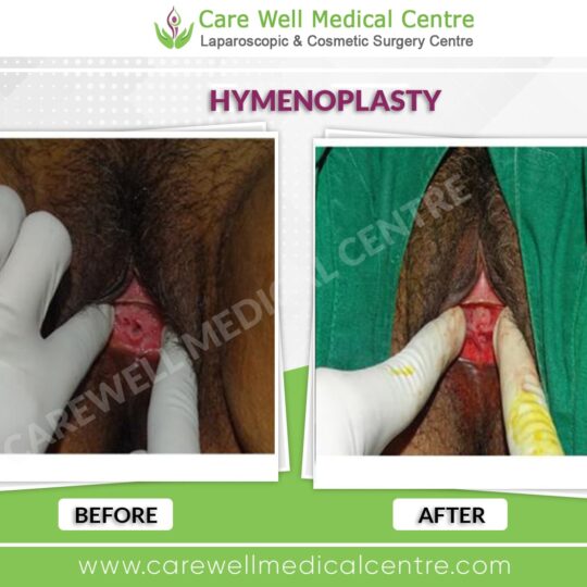 hymenoplasty before and after result image