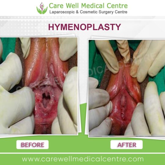 hymenoplasty before and after results