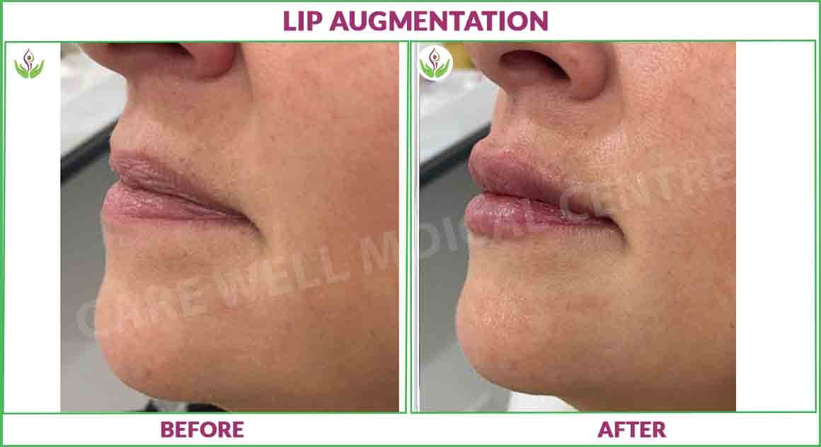 lip augmentation before and after photo