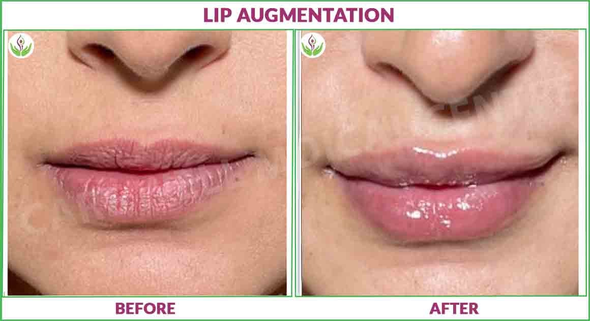 lip augmentation before and after result image