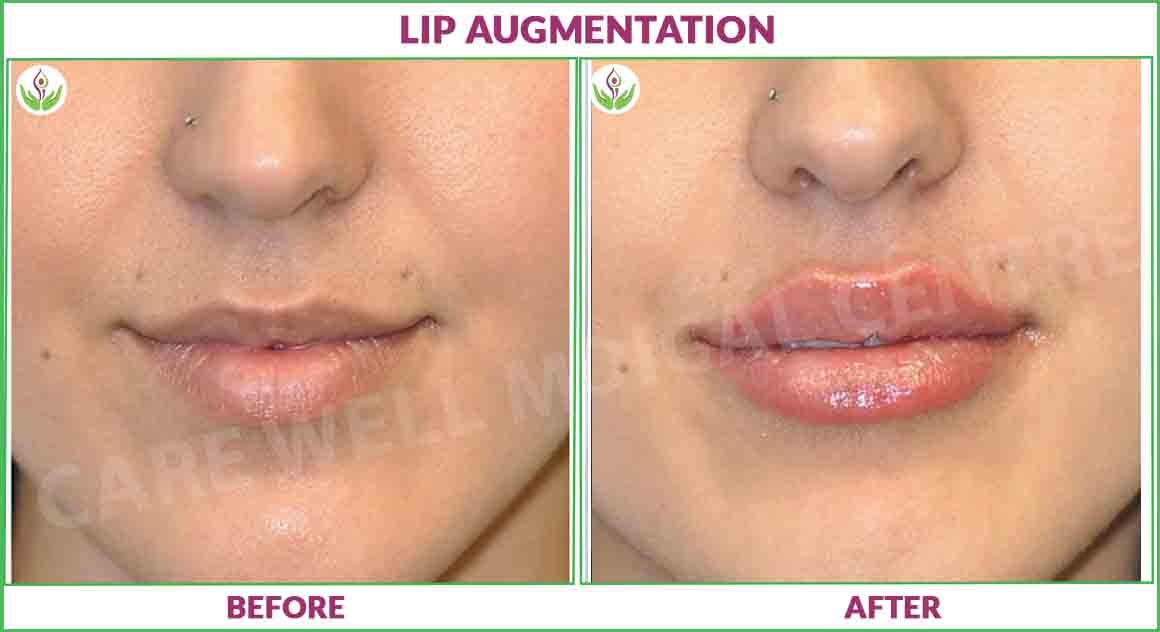 lip augmentation before and after results photo