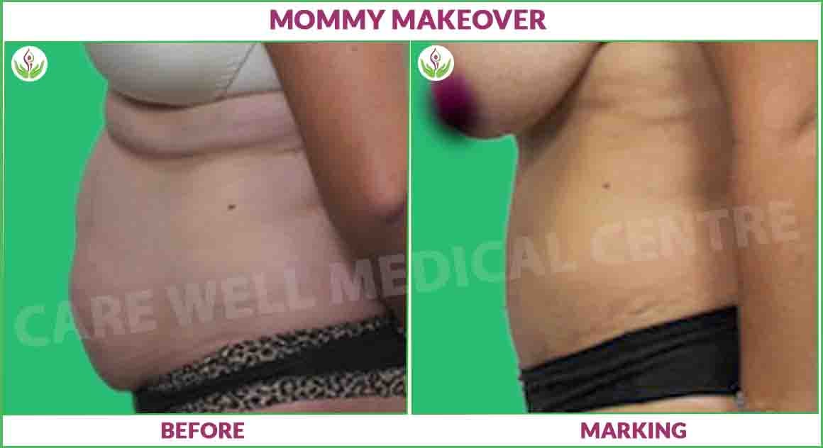 momy makeover before and after result photo