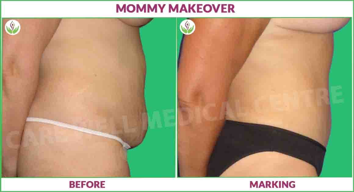 momy makeover before and after results