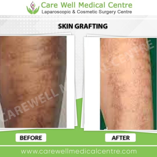 skin grafting before and after result