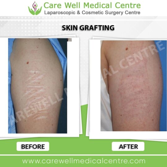 skin grafting before and after result