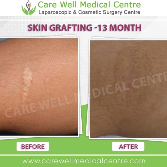 skin grafting before and after result 1