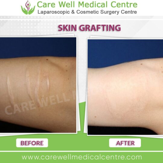 skin grafting before and after result 2