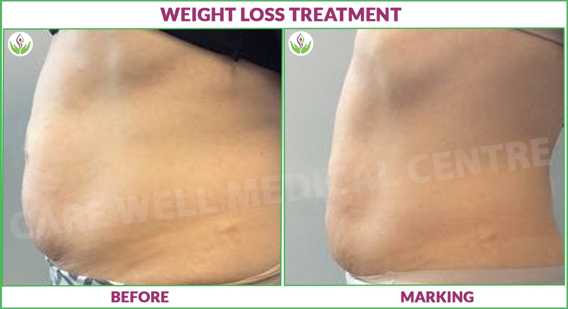 weight loss treatment before and after results