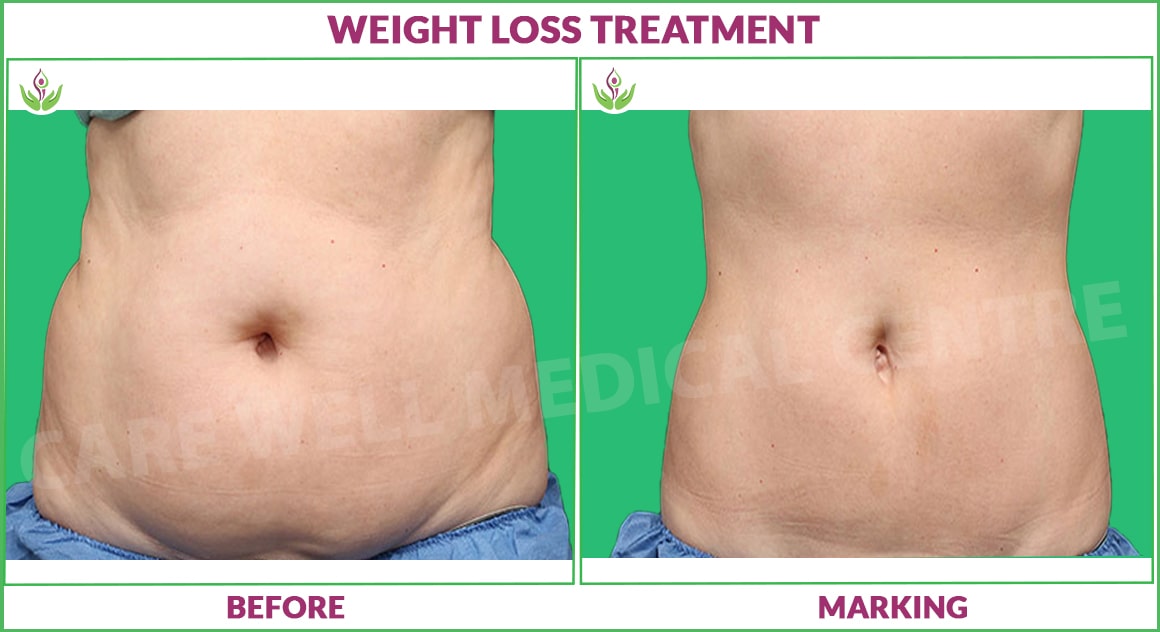 weight loss treatment before and after results photo