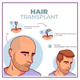 Hair Transplant in Faridabad