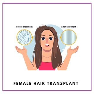 Female Hair Transplantation in Delhi