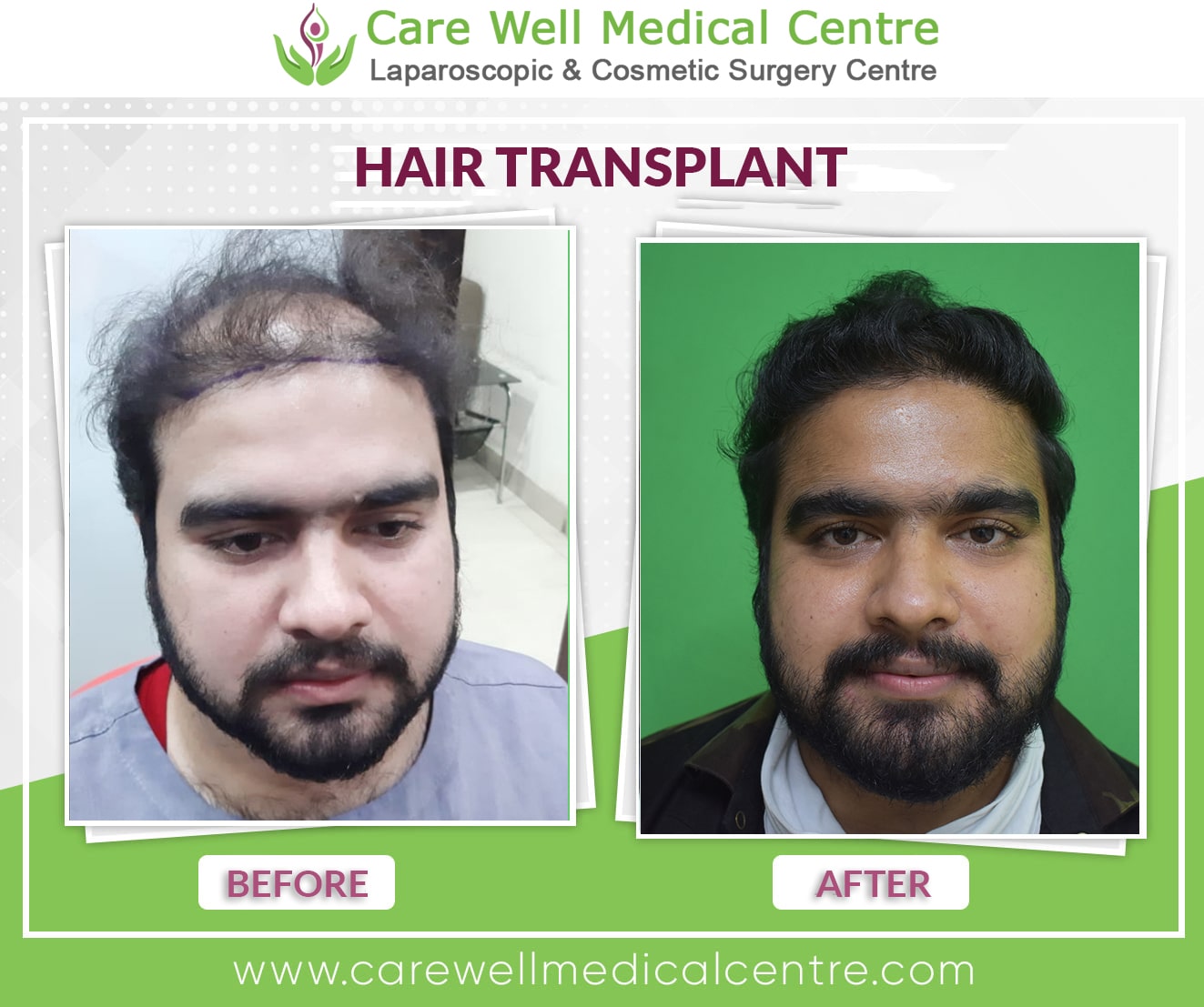 hair transplant before and after result in Faridabad