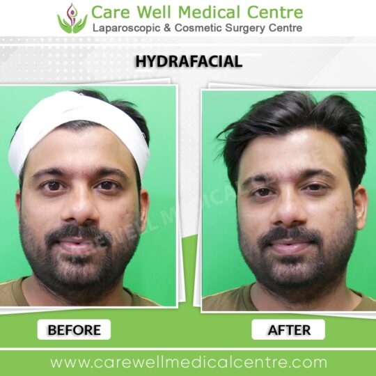 hydrafacial before and after photo 1