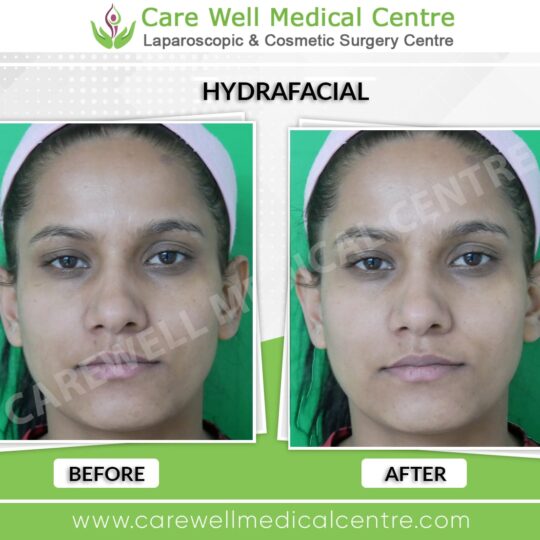 hydrafacial before and after photo