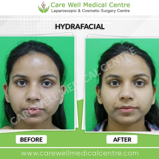 hydrafacial before and after result