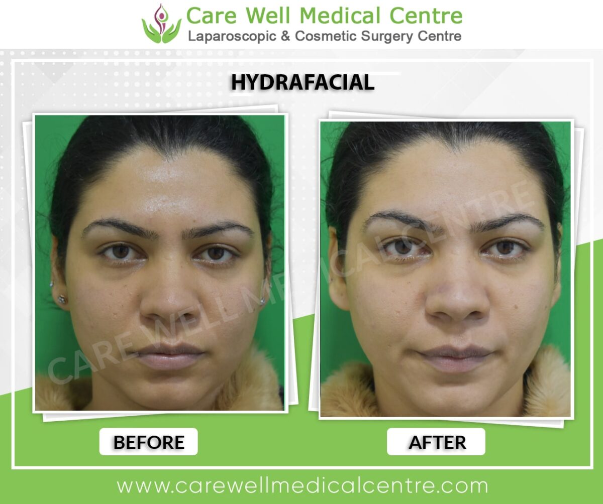 hydrafacial before and after results