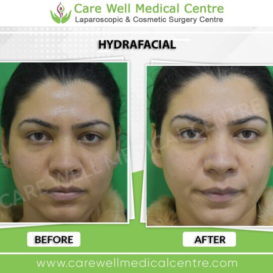 hydrafacial before and after results