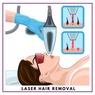 laser hair removal