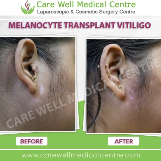 melanocyte transplant before and after