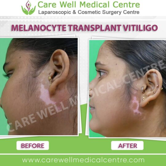 melanocyte transplantation before and after results