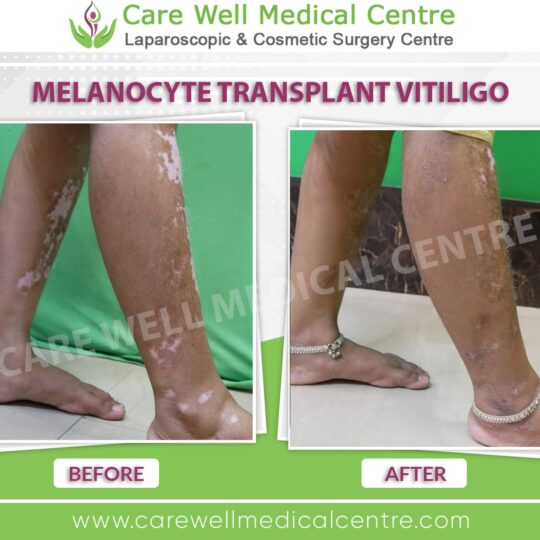 melanocyte transplantation before and after results