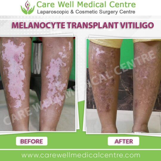 melanocytes transplantation before and after result