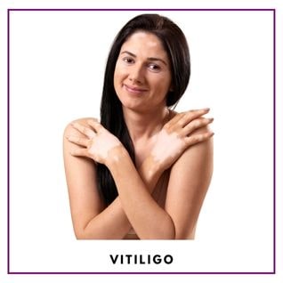 what is vitiligo