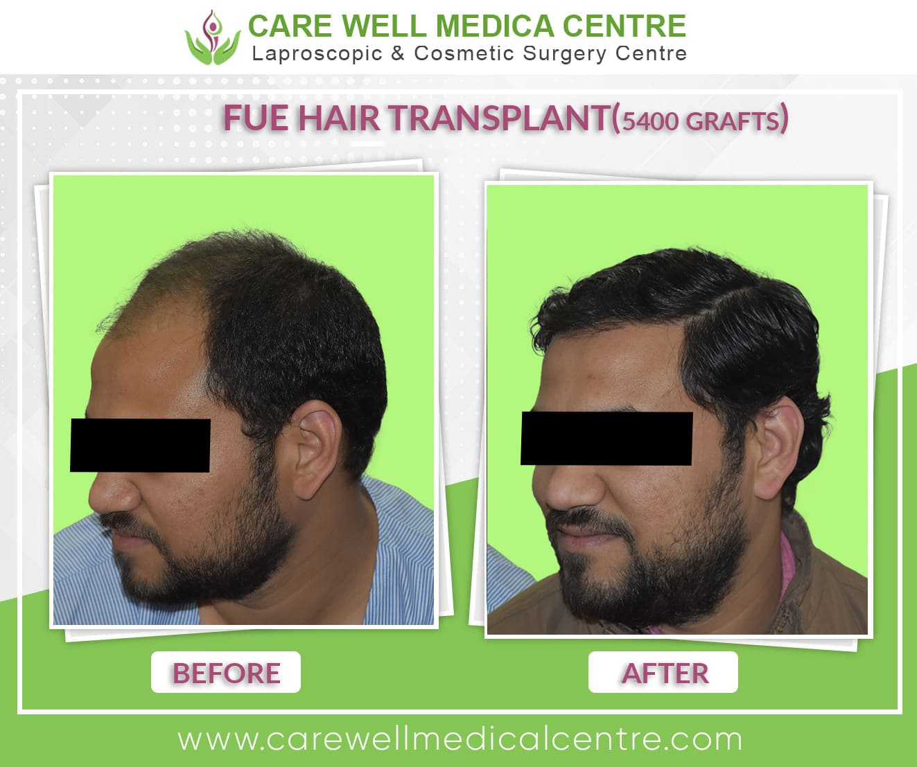 FUE hair transplant before and after in delhi