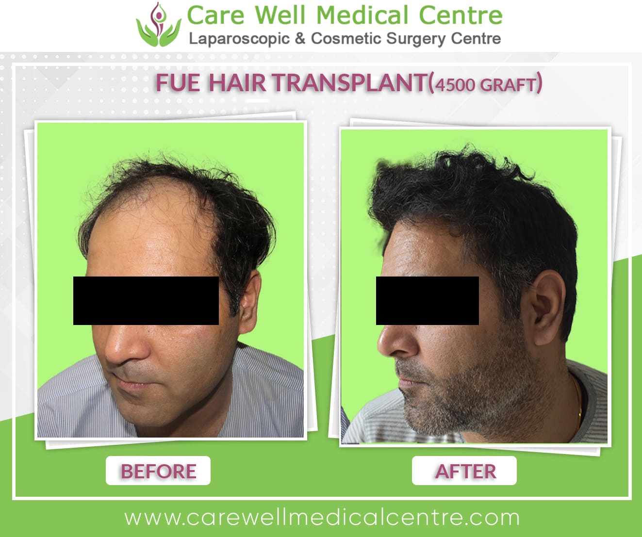 FUE hair transplant before and after in delhi 1