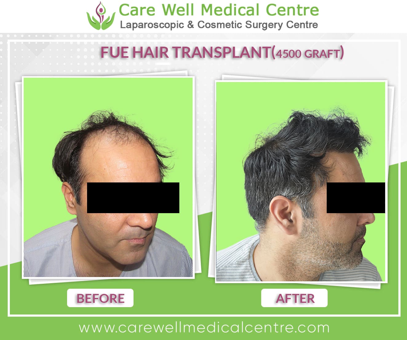 FUE hair transplant before and after in delhi 2