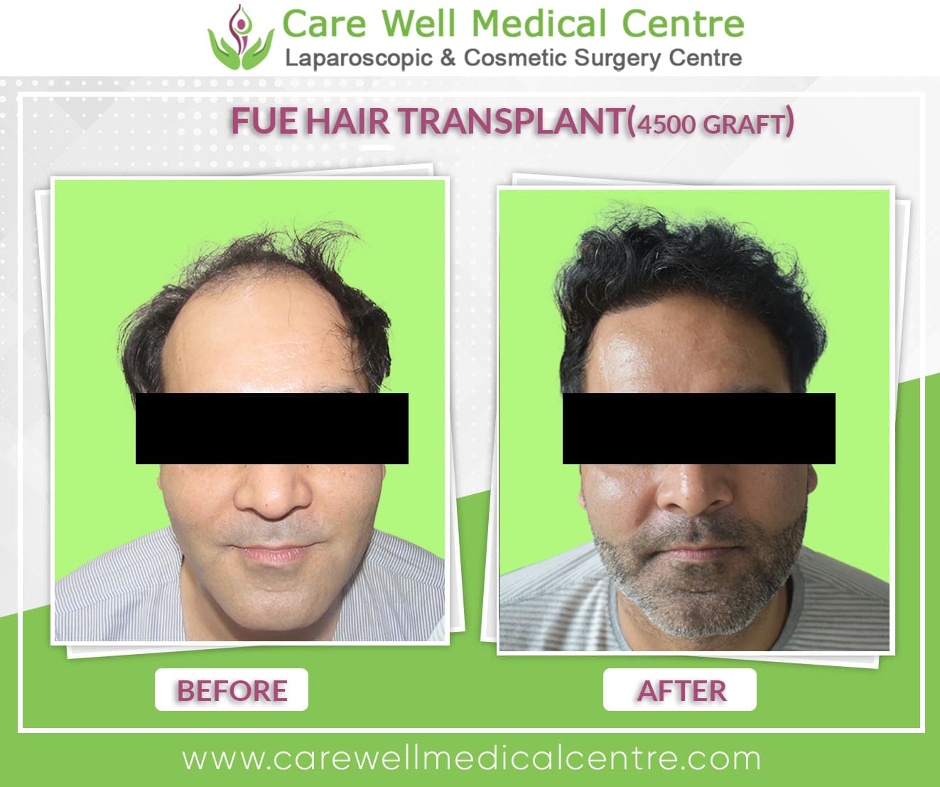 FUE hair transplant before and after in delhi 3