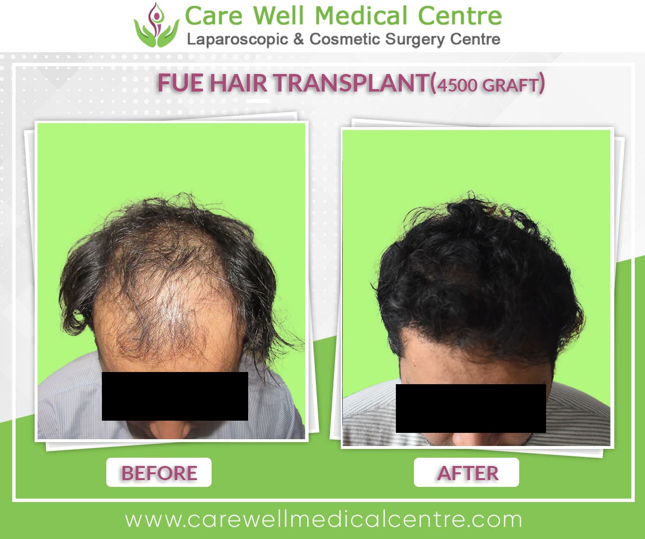 FUE hair transplant before and after in delhi 4