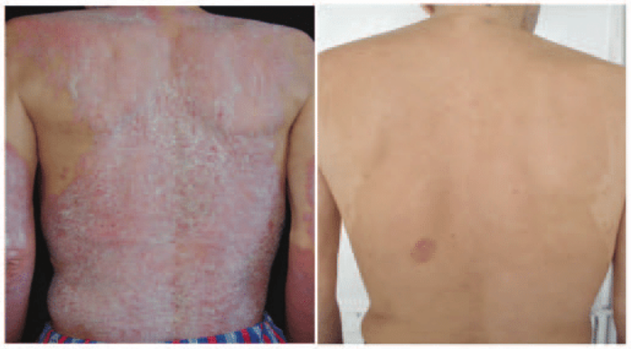 male patient with psoriasis showing improvement after biological therapy.