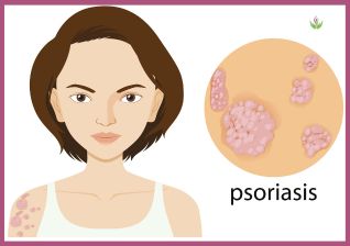 Comprehensive Guide to Psoriasis